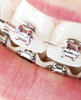 COMMON ORTHODONTIC TREATMENTS